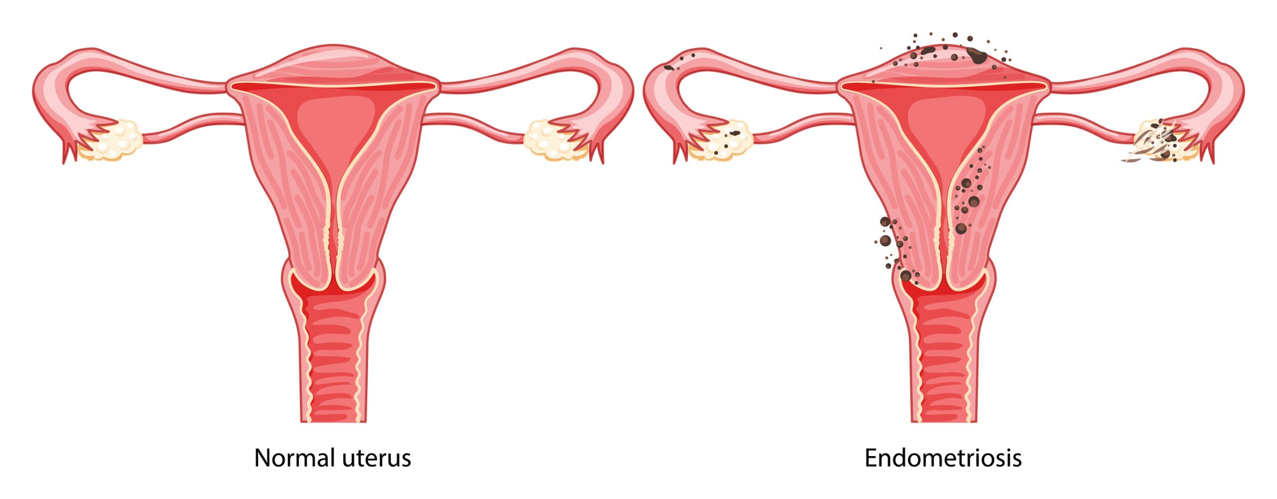 Endometriosis treatment in Ghansoli